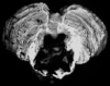 Hypertensive pontine hemorrhage